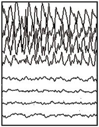 Sequestro parziale EEG