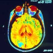 Una risonanza magnetica del cervello può dimostrare se il tumore si è diffuso (metastasi) lì.