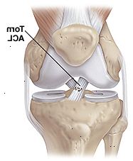 Vista frontale del ginocchio mostrando congiunta muscoli, ossa e legamenti con strappo parziale del legamento crociato anteriore.