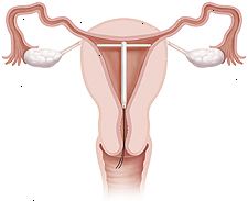 Sezione trasversale di dell'utero e della vagina proiezione IUD in atto all'interno dell'utero.