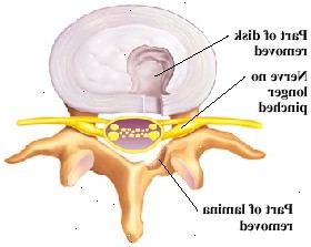 Vista dall'alto di vertebra e del disco. Parte del disco rimosso dal lato posteriore, e parte della lamina rimosso. Nerve non sia schiacciato.