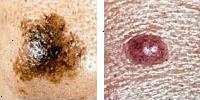 Foto confronto normale e melanoma talpe che mostrano asimmetria