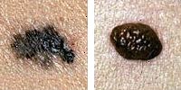 Foto confronto moli normali e melanoma mostrando irregolarità confine