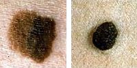 Photo confronto normale e talpe melanoma mostra il colore