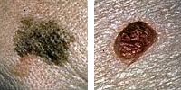 Foto confronto normale e melanoma talpe che mostrano diametro