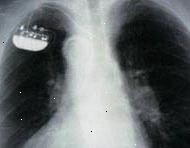 X-ray di un monocamerale impiantato pacemaker