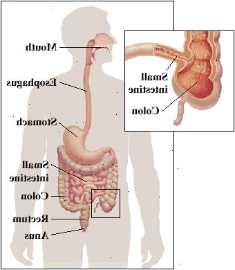 Qualsiasi parte del tratto digerente, dalla bocca all'ano, può essere influenzata. Si trova spesso dove tenue e del colon incontrano.