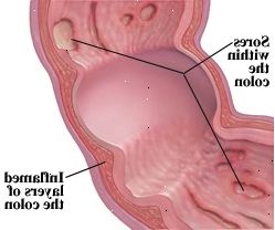 Malattia di Crohn può colpire tutti gli strati del tratto digestivo.