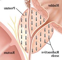 Sezione Primo piano trasversale della vescica, della prostata e del retto. Semi radioattivi vengono impiantati in tutto prostata.