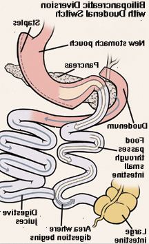 Vista frontale di stomaco e duodeno. Stomaco è stato tagliato e cucito con punti metallici. Tagliare fine del piccolo intestino è stato portato fino a collegarsi allo stomaco. Duodeno è stato tagliato e riattaccato al piccolo intestino. Freccia indica il cibo passa dallo stomaco in abbreviato tenue. Un'altra freccia indica il percorso dei succhi gastrici dallo stomaco attraverso il duodeno e nel piccolo intestino. La digestione inizia nel piccolo intestino.