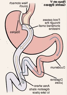 Vista frontale di stomaco e duodeno. Stomaco è stato tagliato e cucito con punti metallici a formare sacchetto. Tagliare fine del piccolo intestino è stato portato fino a connettersi alla tasca gastrica. Duodeno è stato tagliato e riattaccato al piccolo intestino. Freccia indica il cibo passa dallo stomaco in abbreviato tenue. Un'altra freccia indica il percorso dei succhi gastrici dallo stomaco attraverso il duodeno e nel piccolo intestino. La digestione inizia nel piccolo intestino.