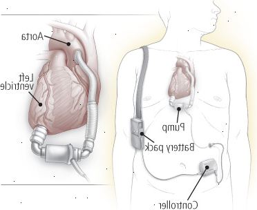 Dispositivo di assistenza ventricolare (VAD)
