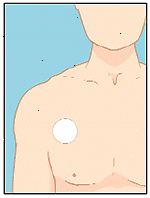 Applicare la patch in un luogo asciutto sul petto, parte superiore della schiena, o parte superiore del braccio.