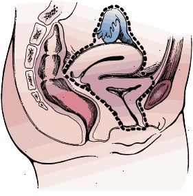 Confini chirurgici di cistectomia radicale in una donna. Il campione comprende la vescica e l'uretra intero, utero, ovaie, tube di Falloppio, e la parete anteriore della vagina.