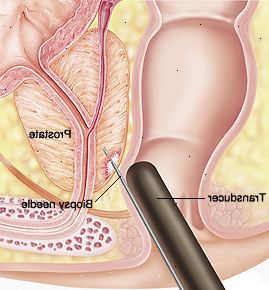 Sezione Primo piano della prostata e del retto. Trasduttore viene inserito nel retto e ago viene inserito prostata.