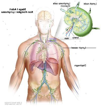 Stadio I adulto linfoma non-Hodgkin; disegno mostra cancro in un gruppo linfonodo sopra il diaframma. Un inserto mostra un linfonodo con un vaso linfatico, un'arteria e una vena. Cellule di linfoma contenenti cancro sono mostrati nel linfonodo.