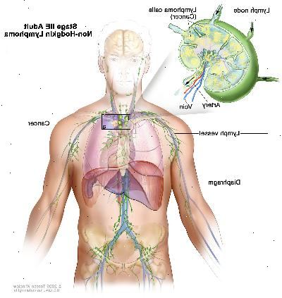Stadio IIE adulto linfoma non-Hodgkin; disegno mostra cancro in un gruppo linfonodo sopra il diaframma e nel polmone sinistro. Un inserto mostra un linfonodo con un vaso linfatico, un'arteria e una vena. Cellule di linfoma contenenti cancro sono mostrati nel linfonodo.