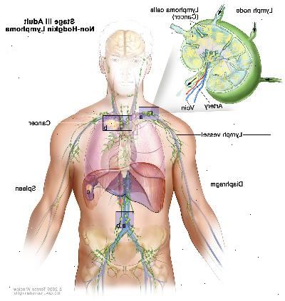 Fase III per adulti linfoma non-Hodgkin. Tumore ha uno o più gruppi di linfonodi sopra e sotto il diaframma (a). Nello stadio IIIE, il cancro si trova in gruppi di linfonodi sopra e sotto il diaframma e fuori dei linfonodi in un organo o zona (b) nelle vicinanze. In fase IIIS, il cancro si trova in gruppi di linfonodi sopra e sotto il diaframma (a) e nella milza (c). In fase IIIS più E, il cancro si trova in gruppi di linfonodi sopra e sotto il diaframma, al di fuori dei linfonodi in un organo o zona (b) nelle vicinanze, e nella milza (c).