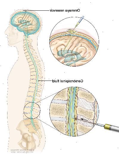 Chemioterapia intratecale. Farmaci antitumorali vengono iniettati nello spazio intratecale, che è lo spazio che contiene il fluido cerebrospinale (CSF, mostrata in blu). Ci sono due modi diversi di fare questo. Un modo, mostrato nella parte superiore della figura, è quello di iniettare farmaci in un serbatoio Ommaya (un contenitore a forma di cupola che è posto sotto il cuoio capelluto durante l'intervento chirurgico, che detiene i farmaci mentre fluiscono attraverso un tubetto nel cervello ). L'altro modo, mostrato nella parte inferiore della figura, è quello di iniettare i farmaci direttamente nel liquor nella parte inferiore della colonna vertebrale, dopo una piccola area sulla parte posteriore inferiore è intorpidì.