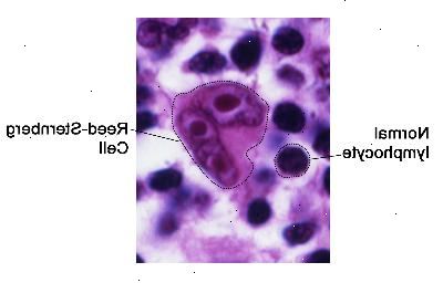 Cellule di Reed-Sternberg. Cellule di Reed-Sternberg sono grandi, linfociti anomali che possono contenere più di un nucleo. Queste cellule si trovano nel linfoma di Hodgkin.