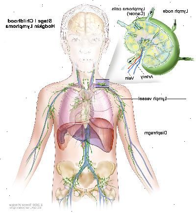 Fase I infanzia Hodgkin; disegno mostra cancro in un gruppo linfonodo sopra il diaframma. Un inserto mostra un linfonodo con un vaso linfatico, un'arteria e una vena. Cellule di linfoma contenenti cancro sono mostrati nel linfonodo.