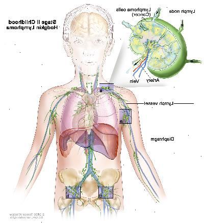 Fase II infanzia Hodgkin; disegno mostra cancro in gruppi linfonodali sopra e sotto il diaframma. Un inserto mostra un linfonodo con un vaso linfatico, un'arteria e una vena. Cellule di linfoma contenenti cancro sono mostrati nel linfonodo.