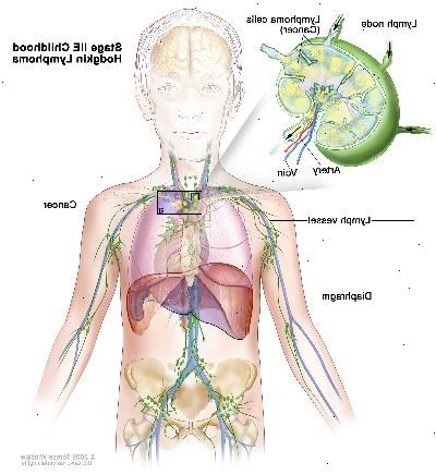 Fase IIE linfoma di Hodgkin infantile; disegno mostra cancro in un gruppo linfonodo sopra il diaframma e nel polmone sinistro. Un inserto mostra un linfonodo con un vaso linfatico, un'arteria e una vena. Cellule di linfoma contenenti cancro sono mostrati nel linfonodo.