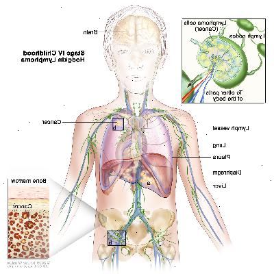 Fase IV infanzia Hodgkin; disegno mostra cancro al fegato, polmone sinistro, e in un gruppo linfonodo sotto il diaframma. Vengono visualizzati anche il cervello e pleura. Un inserto mostra il cancro si diffonde attraverso linfonodi e vasi linfatici ad altre parti del corpo. Cellule di linfoma contenenti cancro vengono mostrati all'interno un linfonodo. Un altro inserto mostra cellule tumorali nel midollo osseo.