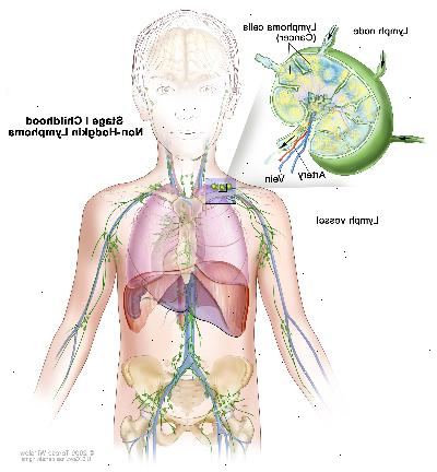Stadio I infanzia linfoma non-Hodgkin; disegno mostra cancro in un gruppo di linfonodi. Un inserto mostra un linfonodo con un vaso linfatico, un'arteria e una vena. Cellule di linfoma contenenti cancro sono mostrati nel linfonodo.