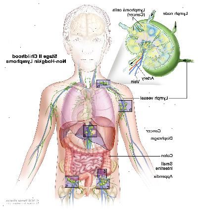 Fase II infanzia linfoma non-Hodgkin; disegno mostra cancro nei gruppi di linfonodi sopra e sotto il diaframma, nel fegato, e in appendice. Sono indicate anche colon e del piccolo intestino. Un inserto mostra un linfonodo con un vaso linfatico, un'arteria e una vena. Cellule di linfoma contenenti cancro sono mostrati nel linfonodo.