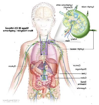 Fase III infanzia linfoma non-Hodgkin; disegno mostra cancro nei gruppi di linfonodi sopra e sotto il diaframma, al petto, e tutto l'addome nel fegato, milza, intestino tenue, e l'appendice. È anche mostrato il colon. Un inserto mostra un linfonodo con un vaso linfatico, un'arteria e una vena. Cellule di linfoma contenenti cancro sono mostrati nel linfonodo.