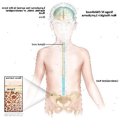 Fase IV infanzia linfoma non-Hodgkin, disegno mostra il cervello, il midollo spinale, e del liquido cerebrospinale in ed intorno al cervello e midollo spinale. Un inserto mostra tumore nel midollo osseo.