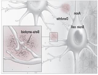 Beta-amiloide placca