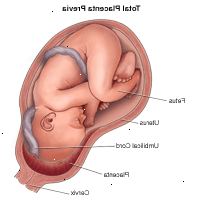 Illustrazione dimostrando totale di placenta previa