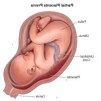 Illustrazione dimostrare parziale placenta previa
