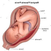 Illustrazione di placenta previa marginale