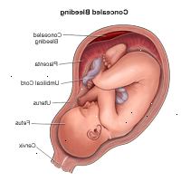 Illustrazione dimostrando nascosto sanguinamento durante la gravidanza