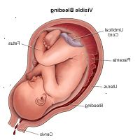 Illustrazione dimostrare sanguinamento visibile durante la gravidanza