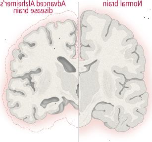 Cambiamenti del cervello nella malattia di alzheimer