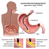 Illustrazione di una procedura esofagogastroduodenoscopia