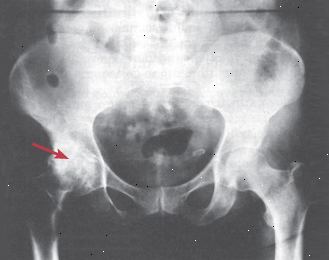 Artrosi dell'anca