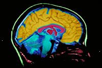 Una foto di un film di scansione MRI del cervello
