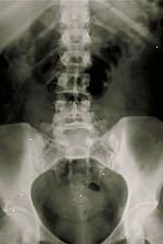 Foto di un lombare x-ray