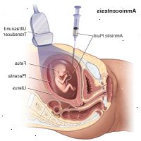Illustrazione dimostrando una amniocentesi