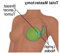 Illustrazione di una mastectomia totale