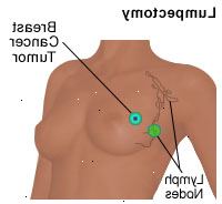 Illustrazione di una mastectomia parziale