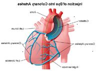 Illustrazione delle arterie coronarie dopo l'iniezione di colorante utilizzato in cateterismo cardiaco o PTCA