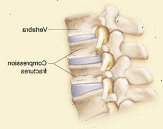 Vista laterale delle vertebre e dei dischi che mostrano fratture da compressione in vertebre.