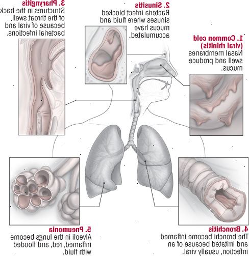 Cinque infezioni del tratto respiratorio