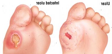 Ulcera del piede
